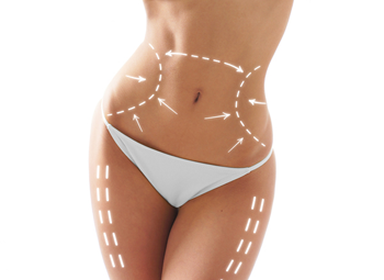 Liposuction